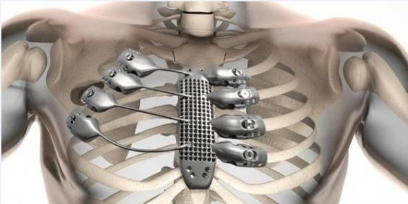 Titanium sternum by 3D printing